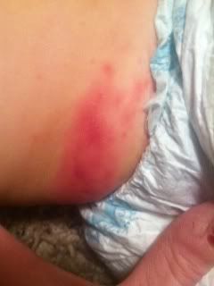 mylanta aquaphor diaper rash